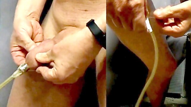 Inflate foreskin with air or balloon