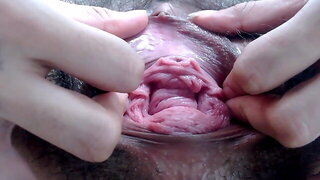 Hairy Anal Prolapse