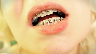 Braces Fetish