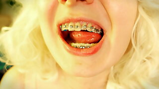 Braces Licking