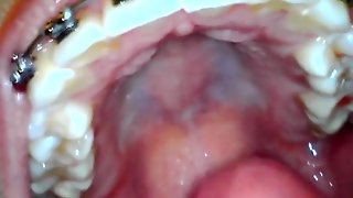 Braced girls uvula endoscope