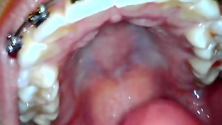 Braces Solo, Braces Fetish, Uvula, Endoscope