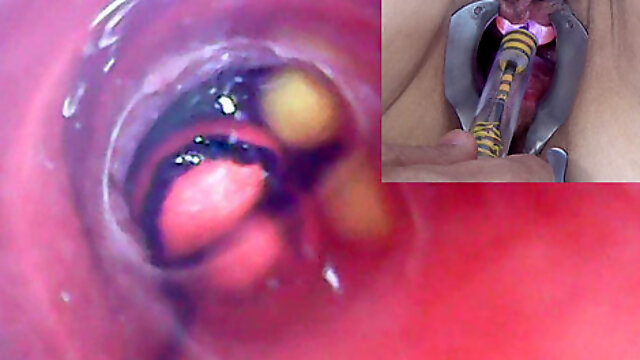 Mature Woman, Peehole Endoscope Camera in Bladder with Balls