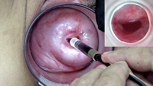 A endoscope japanese camera is inserted in the cervix to watch inside the uterus.